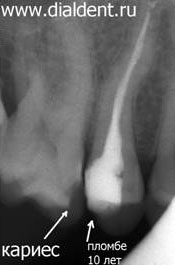 рентген зуба в "Диал-Дент"