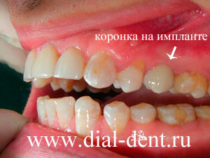 имплантация зубов на Павелецкой в "Диал-Дент"