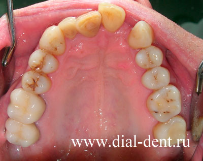 восстановление зубов металлокерамикой и светоотверждаемым материалом