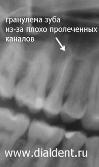 панорамный снимок зубов, гранулема