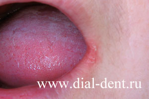 Почему губы трескаются в уголках: причины и способы лечения