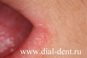 лечение лазером трещин в уголках губ