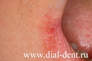 лечение лазером трещин в уголках губ
