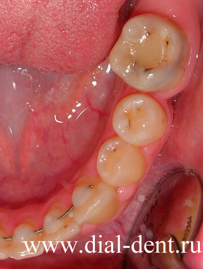 Почему болят зубы: причины и что делать