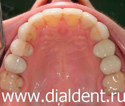 керамические виниры на зубах, чистка зубов Air Flow
