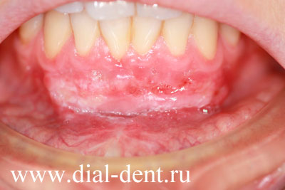 пластика уздечки нижней губы, рецессия десны лечение
