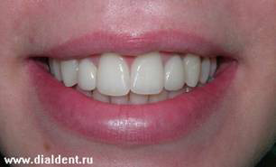 улыбка пациента после установки виниров на зубы