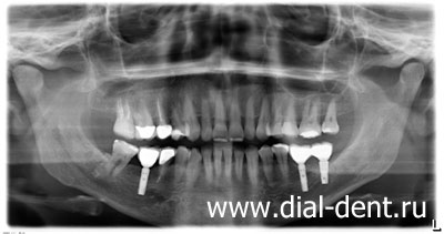 панорамный снимок зубов (ортопантомограмма)