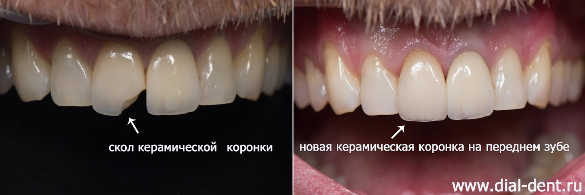 замена сломанной коронки после травмы зуба