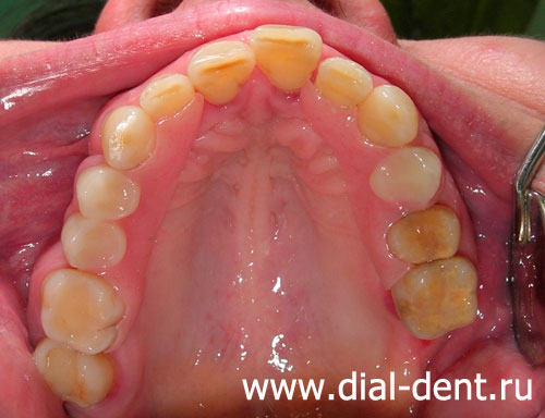 временные зубные протезы установлены пациентке