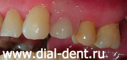 временный зубной протез