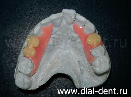 временные зубные протезы на модели