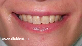 состояние зубов до лечения