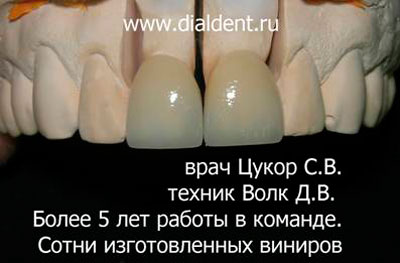 керамические виниры на модели в зуботехнической лаборатории "Диал-дент"