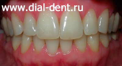 чистка, отбеливание и реставрация зубов в "Диал-Дент"