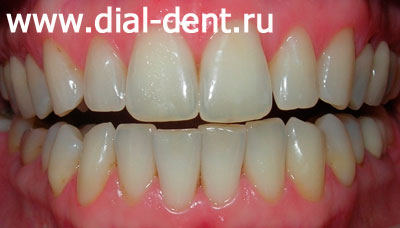 чистка, отбеливание и реставрация зубов в "Диал-Дент"