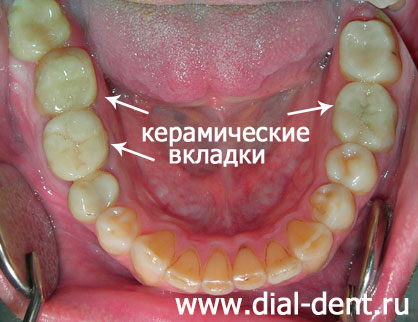 лечение кариеса, лечение каналов зубов, вкладки керамические