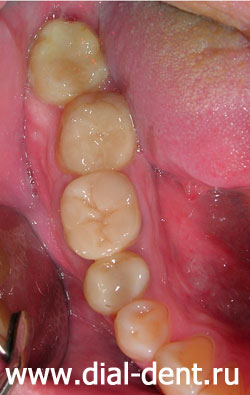 лечение кариеса, лечение каналов зуба, вкладки керамические