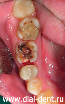 состояние зуба под старой пломбой