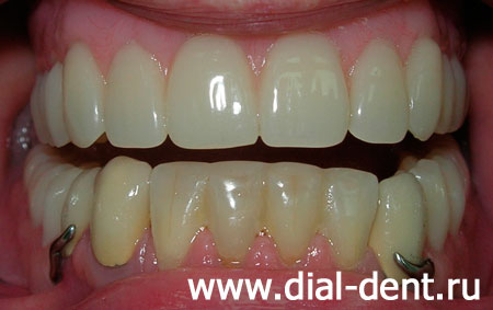 съемные зубные протезы, лечение каналов зубов
