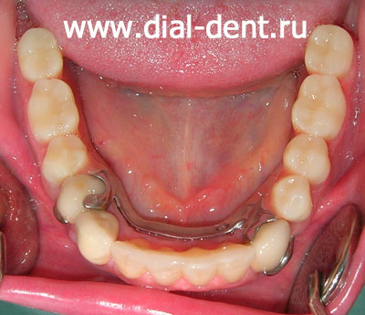 протезирование зубов, бюгельный протез