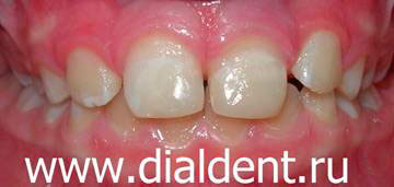 лечение лазером, восстановление зубов