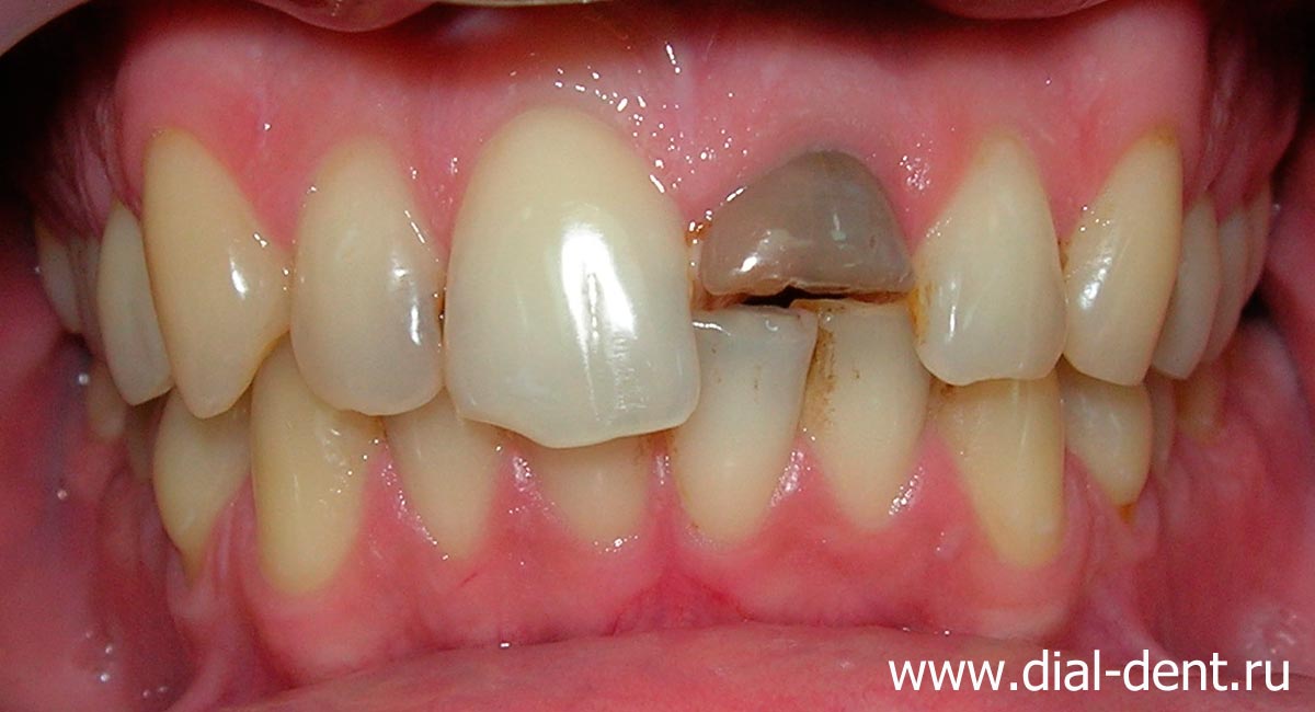 передний зуб после травмы