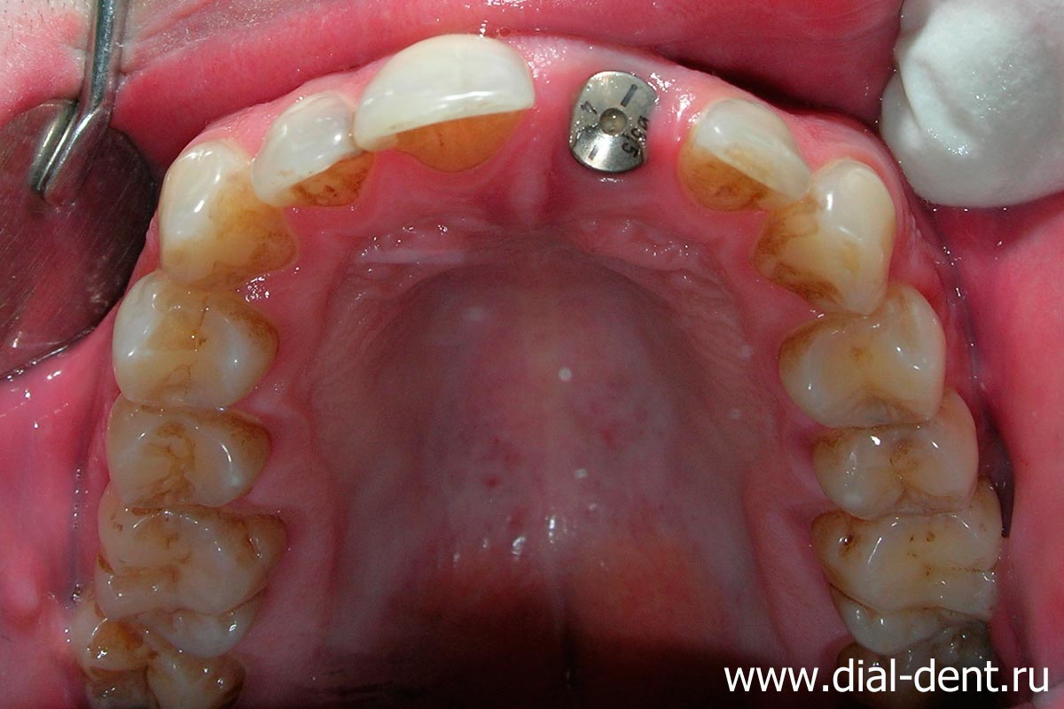 имплантация зуба фото