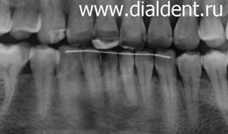 рентген зубов через 5 лет после исправления прикуса