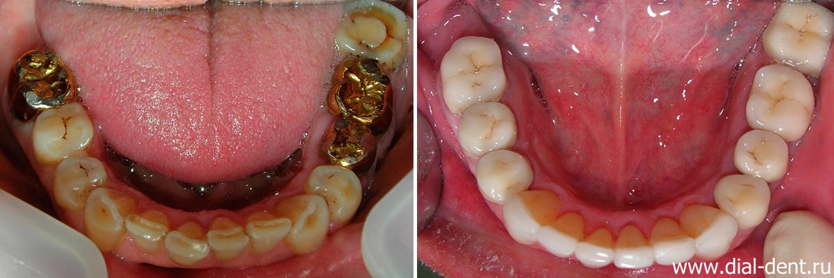 Вид нижних зубов до и после реставрации