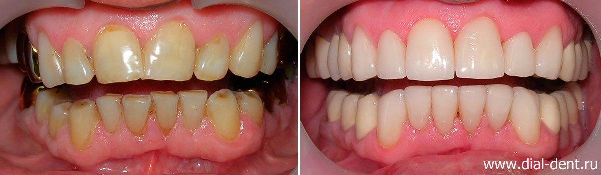 Вид зубов до и после реставрации