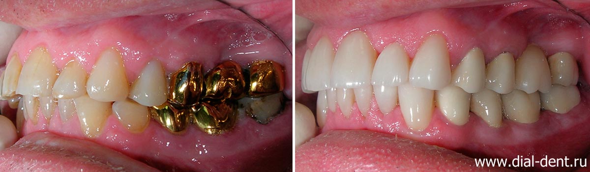 Вид зубов слева до и после реставрации