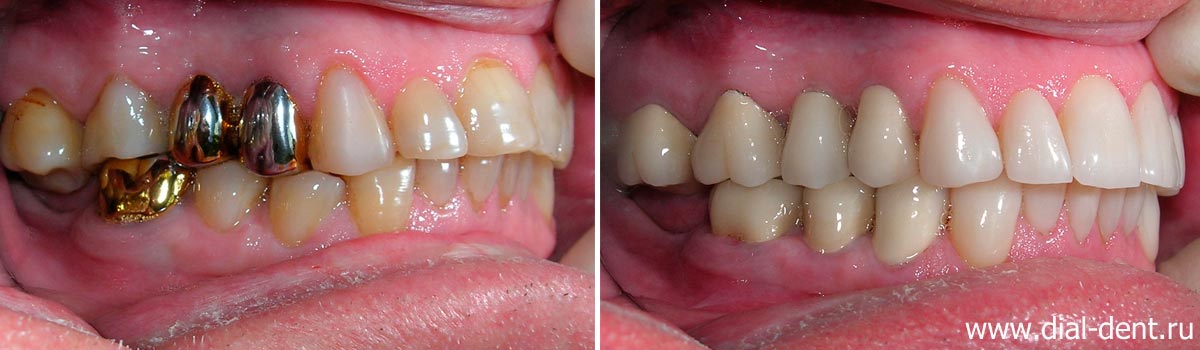 Вид зубов справа до и после реставрации