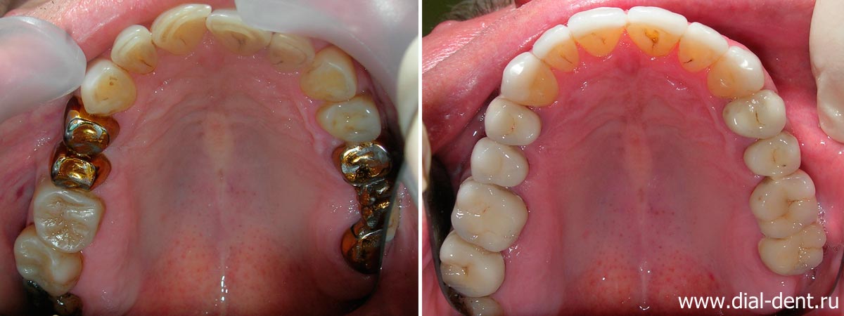 Вид верхних зубов до и после реставрации