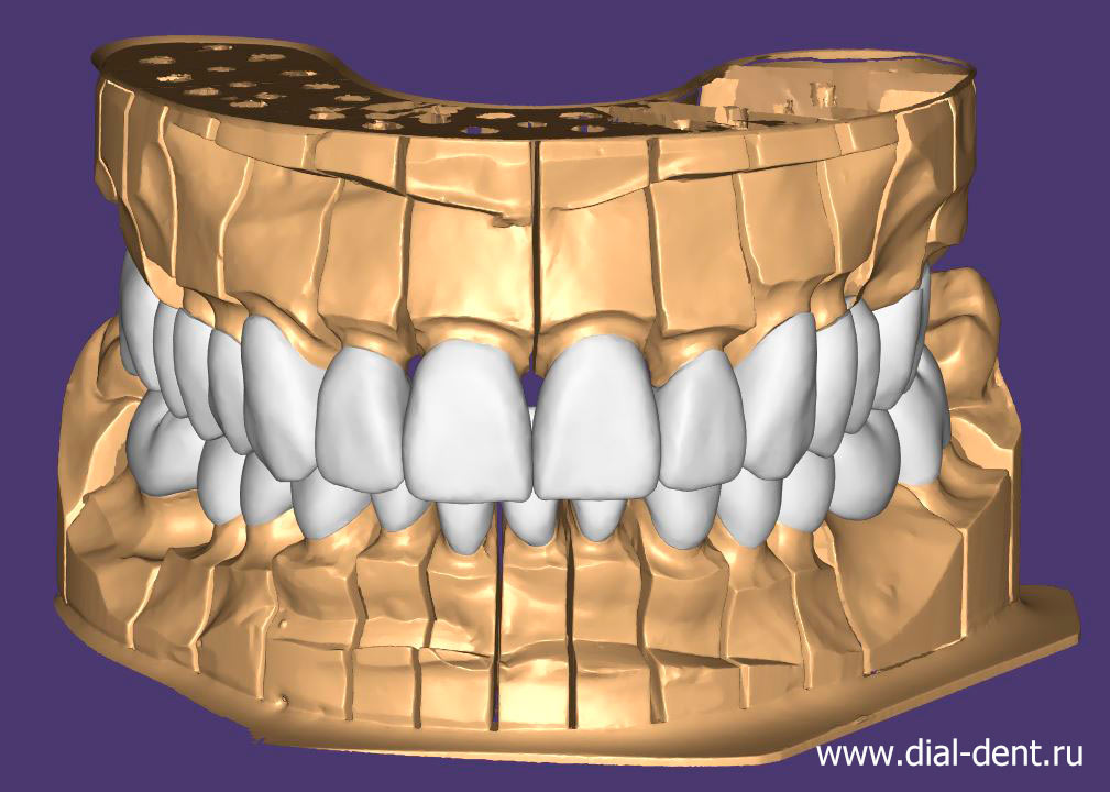 3D моделирование зубных коронок и виниров