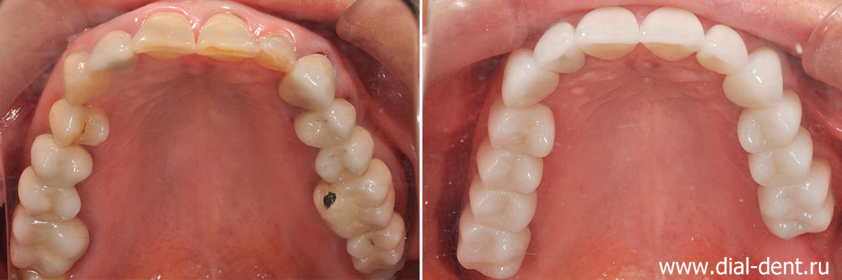 вид верхних зубов до и после протезирования керамикой