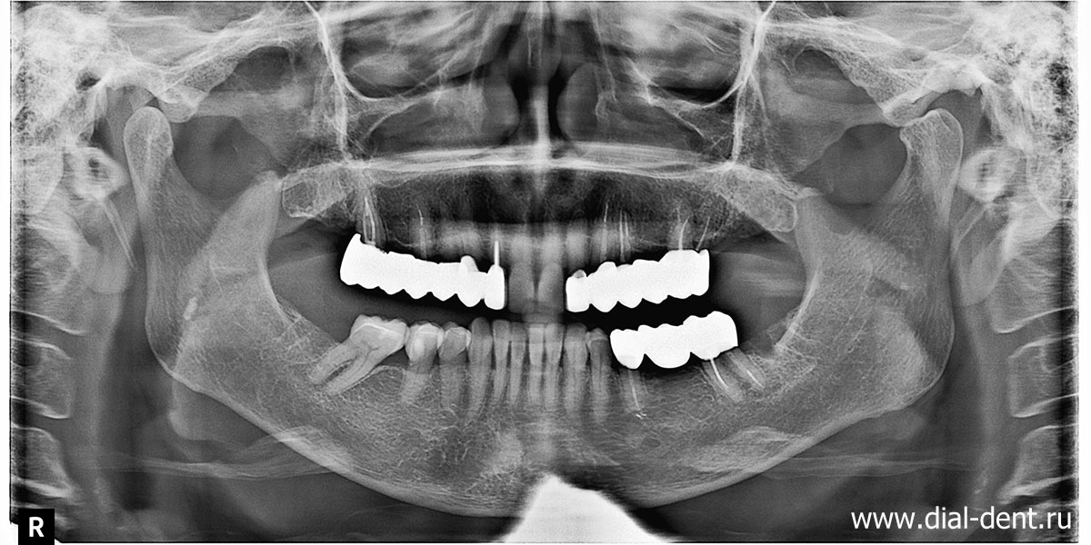 панорамный снимок зубов после лечения и протезирования