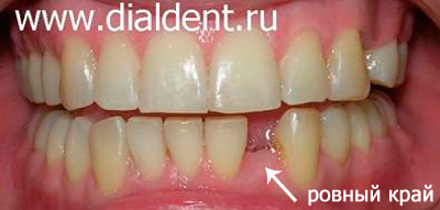 эстетичное протезирование зубов