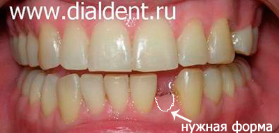 эстетичное протезирование зубов