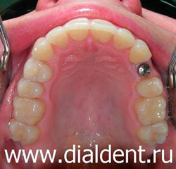 зубные импланты Astra Tech