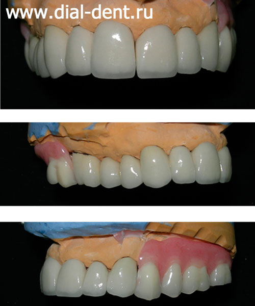 подгонка зубных протезов на модели