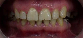 дефекты передних зубов
