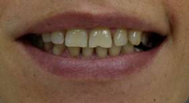 улыбка пациентки до реставрации зубов