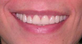 улыбка пацентки после успешно проведенной реставрации зубов винирами