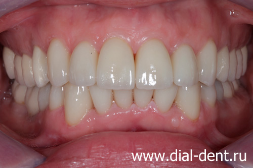 реставрация передних зубов, протезирование на имплантах