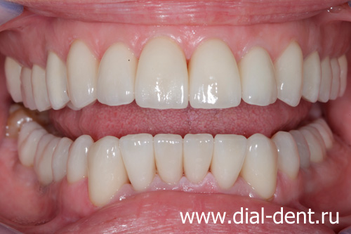 реставрация передних зубов и протезирование на имплантах металлокерамикой