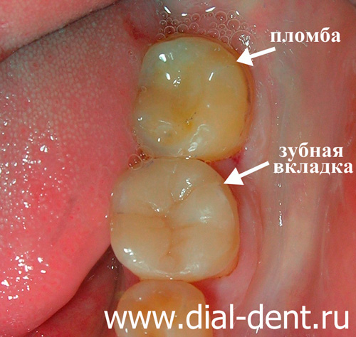 лечение кариеса зубов в "Диал-Дент"