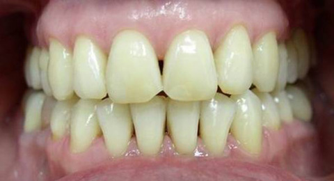 до реставрации зубов: сколы эмали, темные пятна на зубах