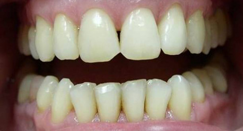 проведена одна процедура отбеливания зубов Opalescence
