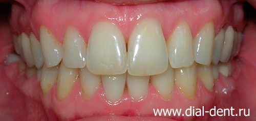 лазерное отбеливание зубов и реставрация дефектов зубов